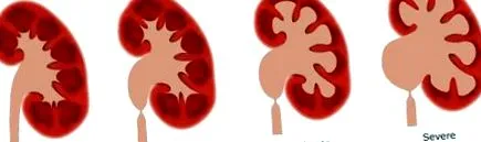 BG-Mamma Hydronephrosis hydronephrosis
