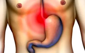 gastritis