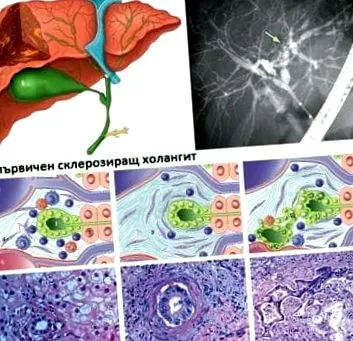 cholangitis akut gennyes