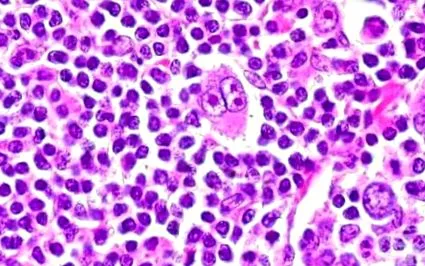 hodgkin-kór lymphogranulomatosisban