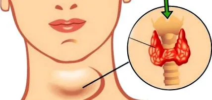 hypothyreosis