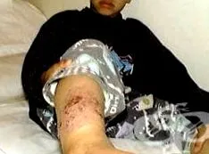 dermatitis atópiás dermatitis