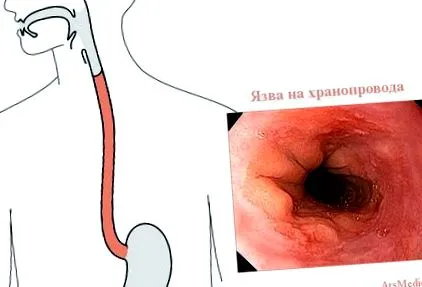 nyelőcső fekély nyelőcső fekély