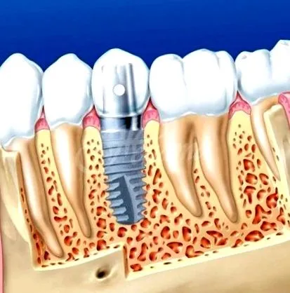 implantátumok csapok