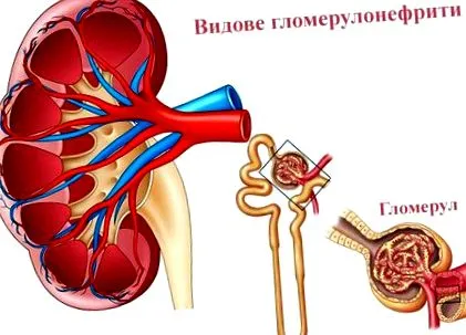 glomerulonephritis típusai