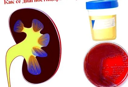 Akut pyelonephritis pyelonephritis