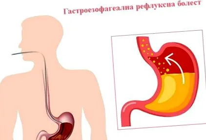reflux gerd