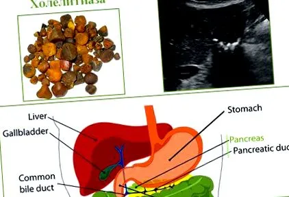 betegség kolelithiasis