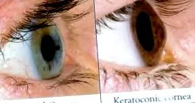 keratoconus keratoconus