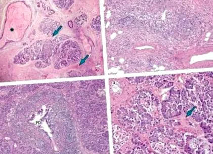 krónikus hasnyálmirigy-gyulladás klinikai