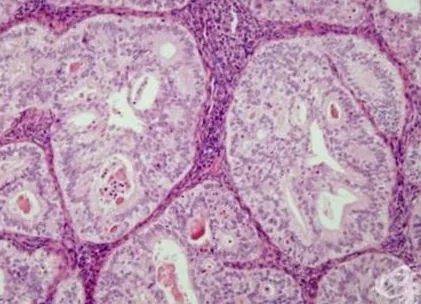 intraepithelialis neoplasia carcinoma