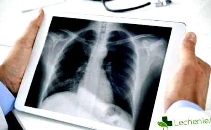 Cavernous tuberculosis tuberculosis