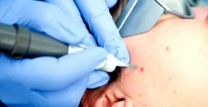 hiperkeratózisa epidermolitikus hiperkeratózis
