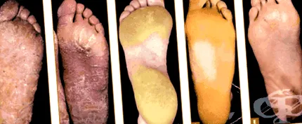 keratosis talpi