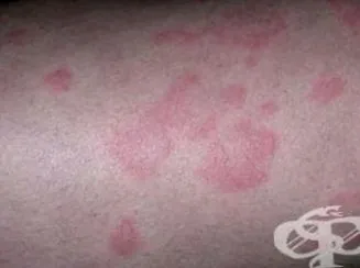 urticaria kapcsolattartó