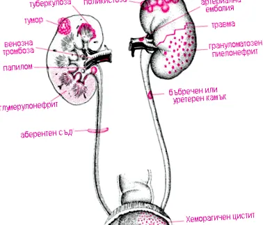 vizeletben hematuria