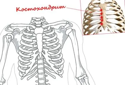 costochondritis