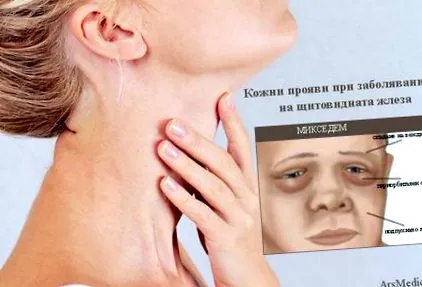 autoimmun betegségek pajzsmirigy