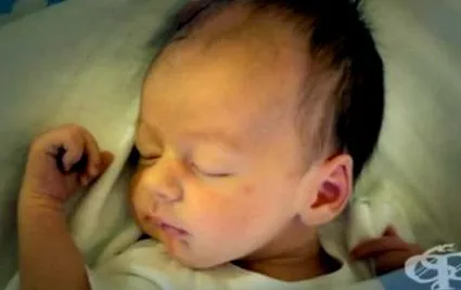 cerebrospinalis folyadék kommunikáló hydrocephalus