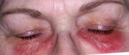 dermatitisz kezelése