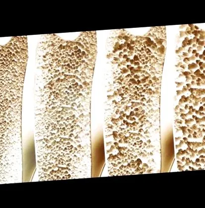 módszer osteoporosis