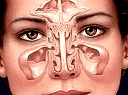 természetes sinusitis