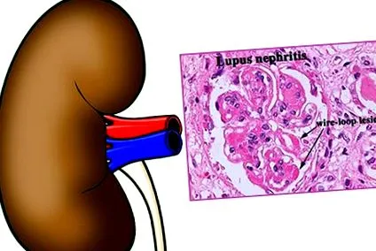 nephropathia