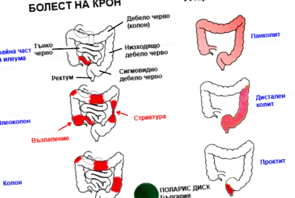 fekélyes crohn-betegség