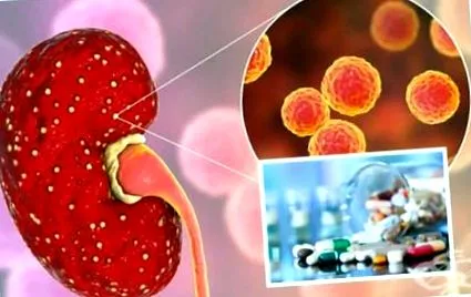 pyelonephritis kezelése izolált bakteriális