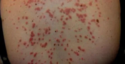 pikkelysömörének pikkelysömörének