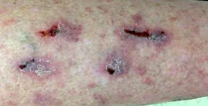 lichen planus