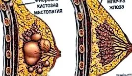 mastopathia mastopathia