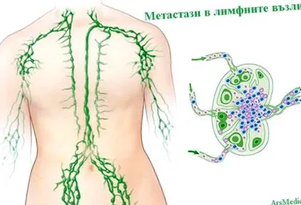 távoli nyirokcsomókban távoli nyirokcsomókban