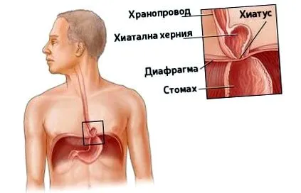 kezelhető-e hiatal