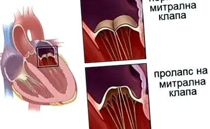szelepes mitrális