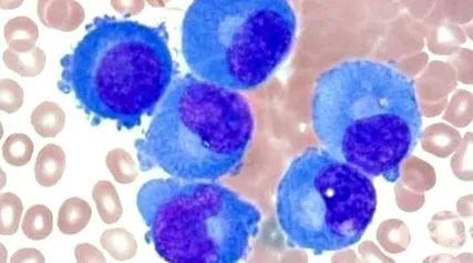 multiplex myeloma multiplex
