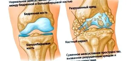 térdízület osteochondrosisának