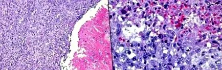 patológia mesenterialis ischaemia