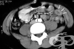 lymphadenitis nemspecifikus