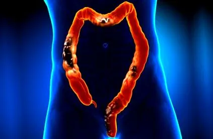 crohn-betegségről