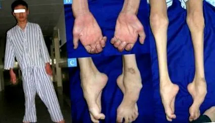 neuropathia szenzoros