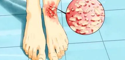 kezelése neurodermatitis