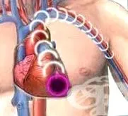 infarktusa myocardialis