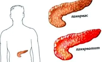 akut hasnyálmirigy-gyulladás hasnyálmirigy