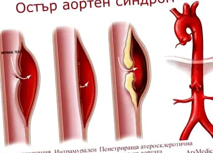 aorta fekély szindróma