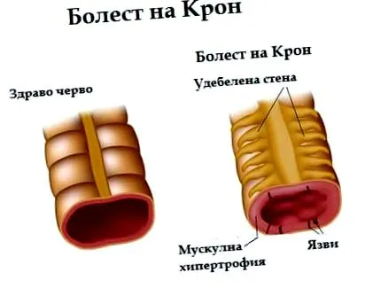 megfelelő crohn-kórt