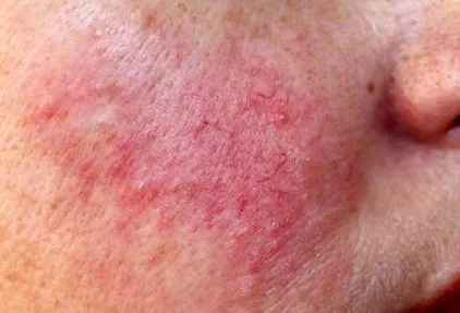 arckiütés discoid lupus