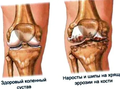 osteoarthritis