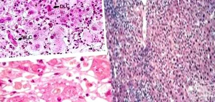 akut hepatitis