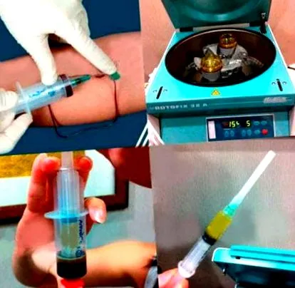 sikeresen alkalmazható gazdag plazmát
